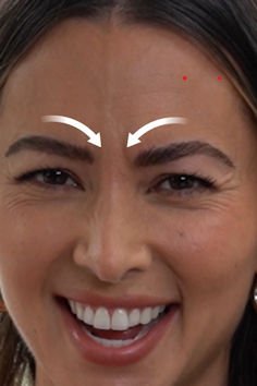 Botox alle