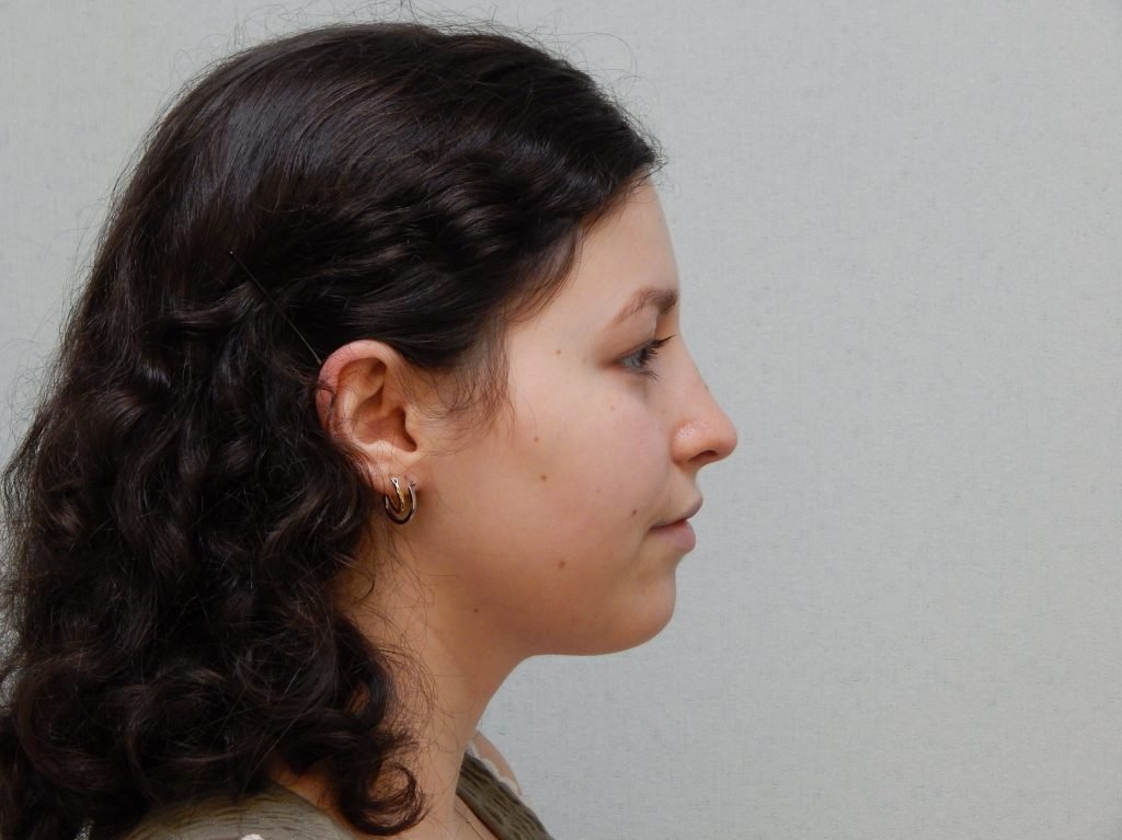 After cosmetic rhinoplasty image