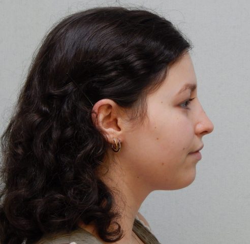 Post-op rhinoplasty right lateral