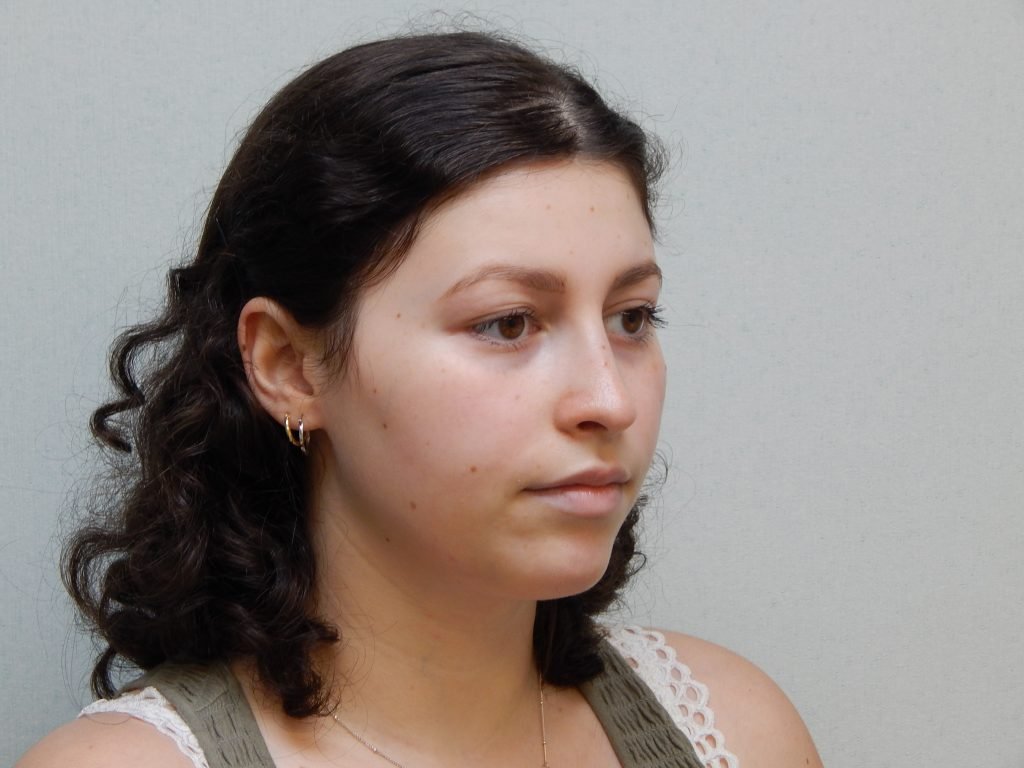 Post-op rhinoplasty right oblique