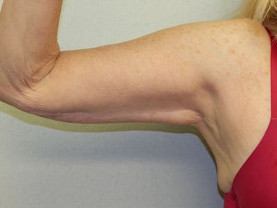 DSCN Rt ant arm aft