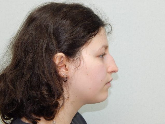 Before nasal surgery