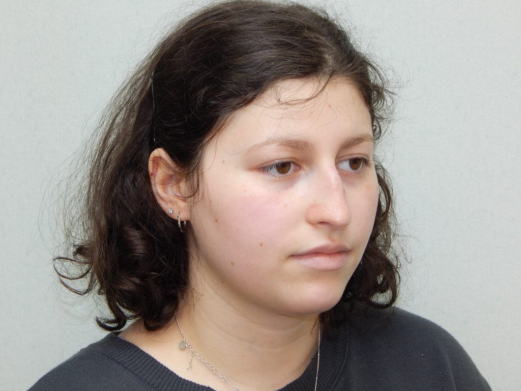 Pre-op rhinoplasty right oblique