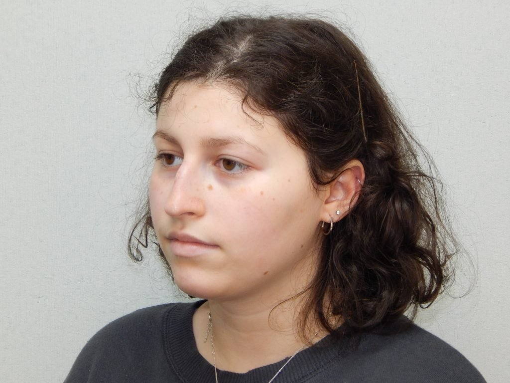 Post-op rhinoplasty left oblique