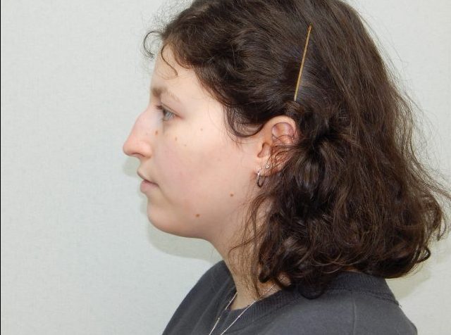 Preop rhinoplasty left lateral